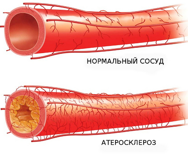 Как развивается атеросклероз аорты